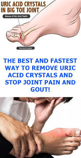 Pin On Gout