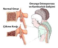 Hatta ilk kırık meydana gelinceye dek herhangi bir bulgu. Osteoporoz Kemik Erimesi Prof Dr Levent Altinel Antalya Ortopedi Doktoru Meniskus On Capraz Bag Diz Protezi Kalca Protezi Ortopedi Ve Travmatoloji Ortopedi Uzmani Ortopedi Cerrahisi Kireclenme Omuz Artoskopisi Kirik Tedavisi