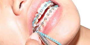 However, in some cases, orthodontic treatment can take up to two and a half years. 5 Steps For Getting Your Braces Removed