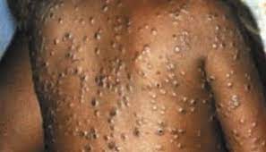 The states affected include bayelsa, rivers, ekiti, akwa ibom, lagos, ogun and cross river. Britain Reports Case Of Male Contracting Monkey Pox Thailand Medical News