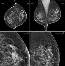 But radiologists can still see signs of cancer. Ai Tool Improves Breast Cancer Detection On Mammography Eurekalert Science News