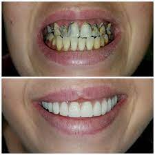Now, i wish i would have decided to do this years ago. Dentures Partials In Garland Tx Dentures Near Me