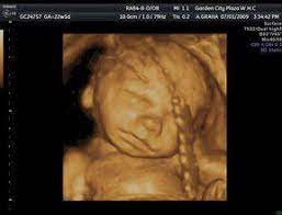 3d 4d Ultrasound Upper East Side New York Ny Garden Ob Gyn
