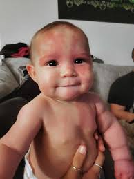 Hi everyone of Columbia County. This is Zaya, she is 6 months old and has  Port Wien Stain birthmark covering different parts of her body, head to  literal toe ! and has