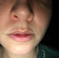 Depending on how bad your scarring is, you're not going to get the results you want at a regular esthetician. Skin Concern How Do I Get Rid Of This Red Acne Scar Above My Lip Skincareaddiction