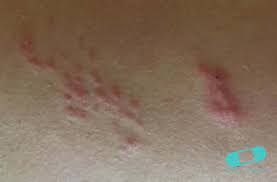 Tal vez usted recuerde haber tenido varicela cuando era niño. Herpes Zoster Culebrilla Guia De La Piel