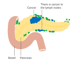 Plus, people usually have no symptoms until the cancer the pancreas is nestled right near the small intestine near the first part of the small intestine, and tumors can cause food to. A Diabetes Diagnosis May Be First Symptom Of Pancreatic Cancer Diabetes Daily
