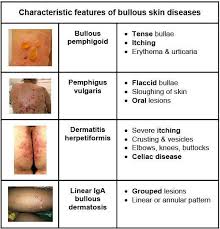 Image result for Pemphigoid
