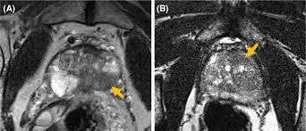 Your prostate cancer&#x27;s been &quot;cured&quot; Multiparametric Mri And Radiomics In Prostate Cancer A Review Springerlink