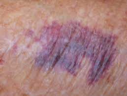 I, too, get deep purple spots on my arms. Senile Purpura Dermnet Nz