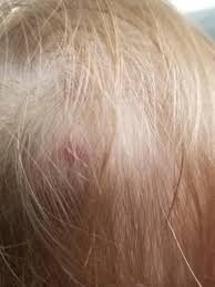 It is also known as senile angioma or a campbell de morgan spot, a cherry angiomas are common in people aged 30 and above. Any One Have A Kid With A Hemangioma Strawberry Birthmark Question In Comment Daddit