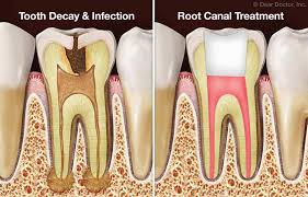Because we respect your right to privacy, you can choose not to allow some types of cookies. Root Canal Treatment Faqs Mount Vernon New York
