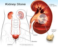 Kidney Stone Treatment In New Delhi Gagan Vihar By Tirupati Stone Centre Private Limited Id 2957429591