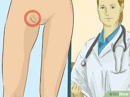 Como Tratar Uma Lesao Na Virilha Com Imagens Wikihow