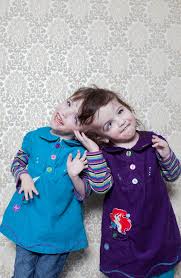 Two man deep south gorenoisemembers:$n0t: Could Conjoined Twins Share A Mind The New York Times