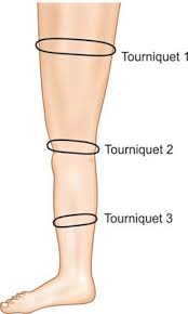 Image result for Perthes Test