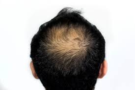 Hairline maturation isn't always a sign of male pattern. Hair Loss In Men Boss Clinic