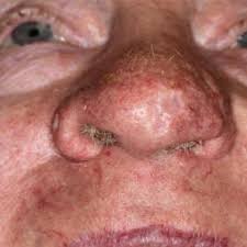 Nasal vestibulitis is the diffuse dermatitis of nasal vestibule. Triage Detect Disease In A Snap