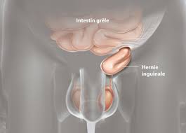 Hernie De L'aine | Ramsay Santé