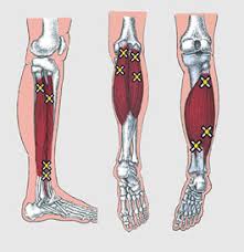 calf trigger points