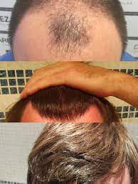 1 Year Hair Transplant Tressless
