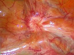 Our goal is to improve awareness and enhance. Endometriose Eref Thieme
