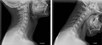 They show pictures of your internal tissues, bones, and organs. Orthobullets A Normal Cervical Spine Lateral Radiograph Facebook