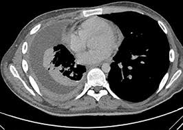 Image result for Pleural Tuberculosis