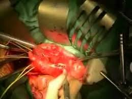 Check spelling or type a new query. Chirurgie D Un Anevrysme De L Aorte Abdominale Youtube