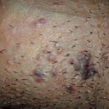 Still, because the razor makes direct contact with the skin to remove the hair at its base, shaving can cause. Ingrown Hair On Penile Ingrown Hair