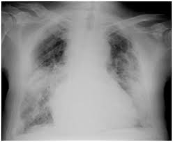 Image result for Hyperviscosity Syndrome