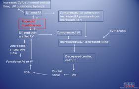 Image result for Delayed Transition from Fetal Circulation