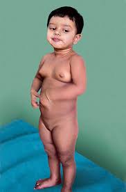 Image result for Precocious Puberty