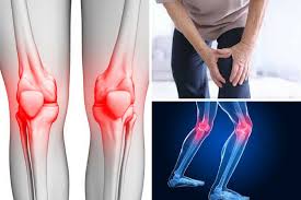 Rasa sakit di punggung bagian belakang atau low back pain dapat dialami oleh segala kalangan usia, tetapi lebih sering diderta oleh anda lansia atau orang yang berusia di antara 30 sampai 50 tahun ke atas. Cara Mengatasi Sakit Pinggang Com Harga Ulasan Bahan Komposisi