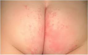 Image result for diaper dermatitis