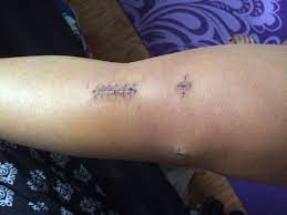 No More Staple Or Stitches Acl Surgery Fish Tattoos Jesus Fish Tattoo