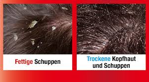 Schuppen Unterschied Fettige Trockene Schuppen