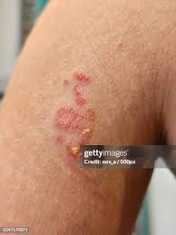 Image result for Pustule