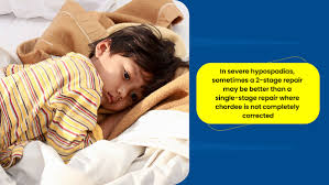 Image result for Chordee