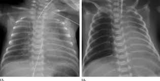 Increased radiolucency of the ipsilateral lung and sharpness of mediastinal border are the earliest signs of pneumothorax. 14 13 Asymmetric Surfactant Effect In A 2 Day Old Download Scientific Diagram