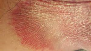 Image result for itchy skin rectum