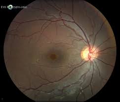 X Linked Retinoschisis Xlrs Fundus Photography Eye Health Eyes