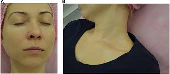 Asi que la sustancia entra por via oral y por via topica. Vitiligo New Treatment Approach Ccid