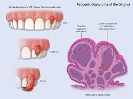 Image result for granuloma gum disease