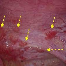 Die symptome sind sehr umfangreich und unspezifisch. Types Of Endometriosis Ifem Endo