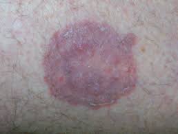 Tinea corporis and cruris infections are usually treated for two weeks, while tinea pedis is treated for four weeks with an azole or for one to two weeks with allylamine medication. Tinea Corporis Images Dermnet Nz