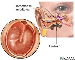 When to see a doctor about water in your ear? Ear Infection Chronic Medlineplus Medical Encyclopedia