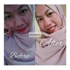 Jual PAKET HEMAT ACNE 2