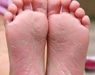 Skin care products are used to improve the condition of the skin. Young Girl Presents With Peeling Soles On Her Feet