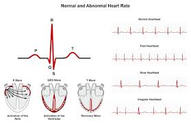 Irregular heartbeat or arrhythmias is experienced by countless people around the world at some point during the course of their life. Arrhythmia Carolina Heart And Leg Center